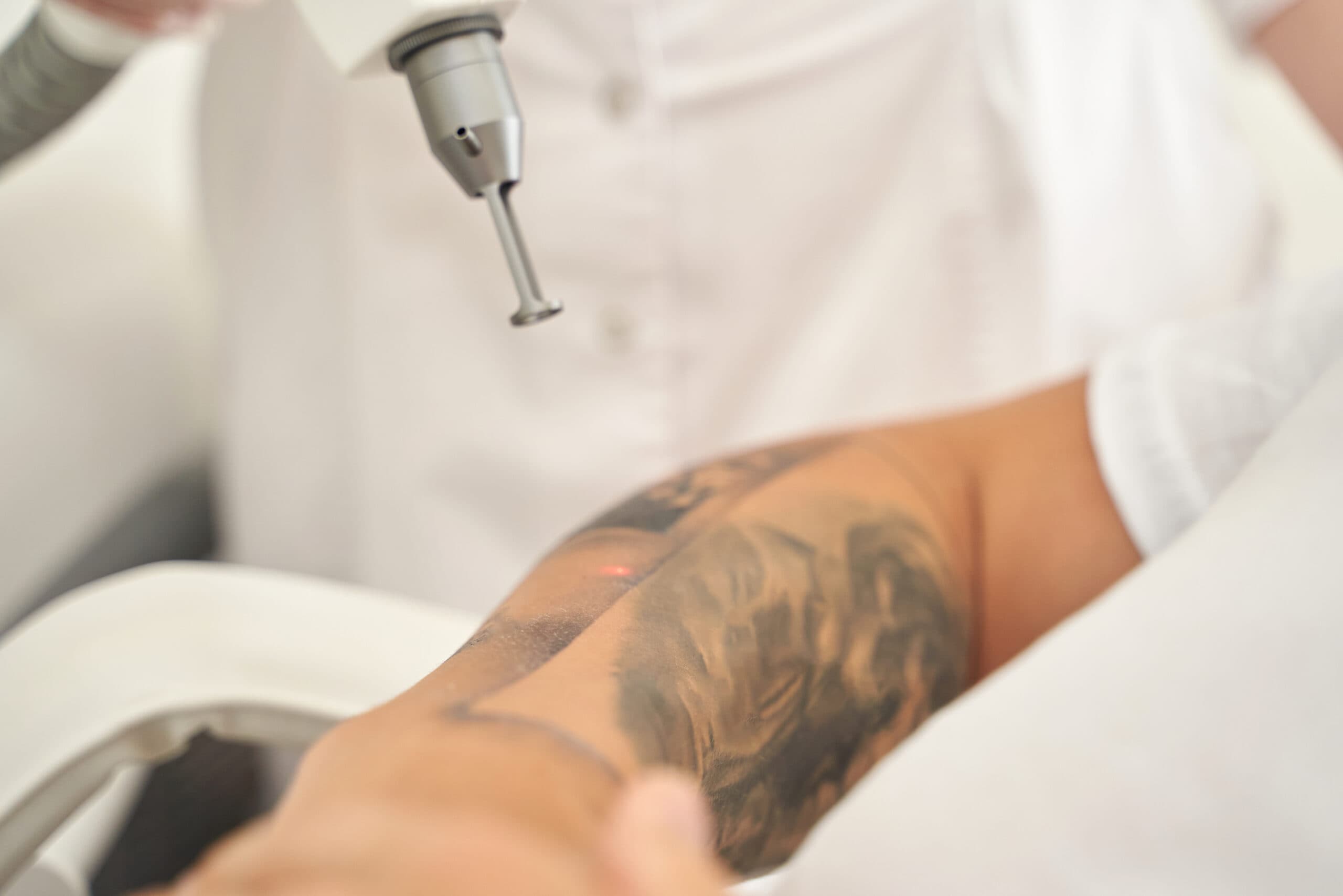 Tattooentfernung mit dem Laser